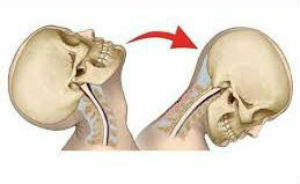 Tractament osteopàtic per les fuetades cervicals