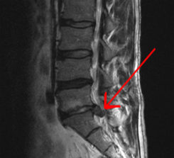 Lumbalgia o hernia discal